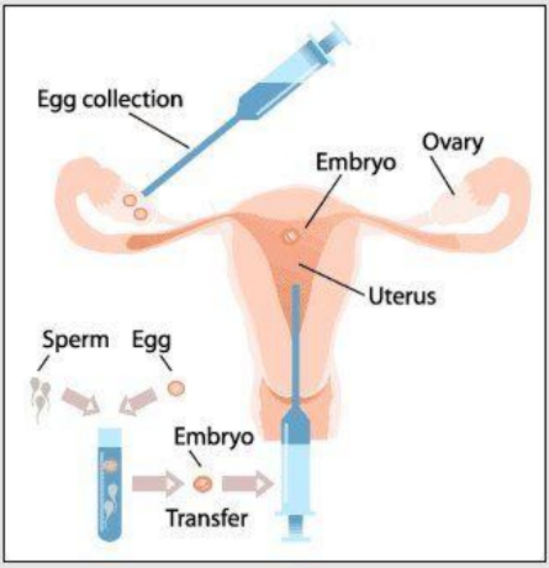 steps-of-ivf-optimized What is IVF